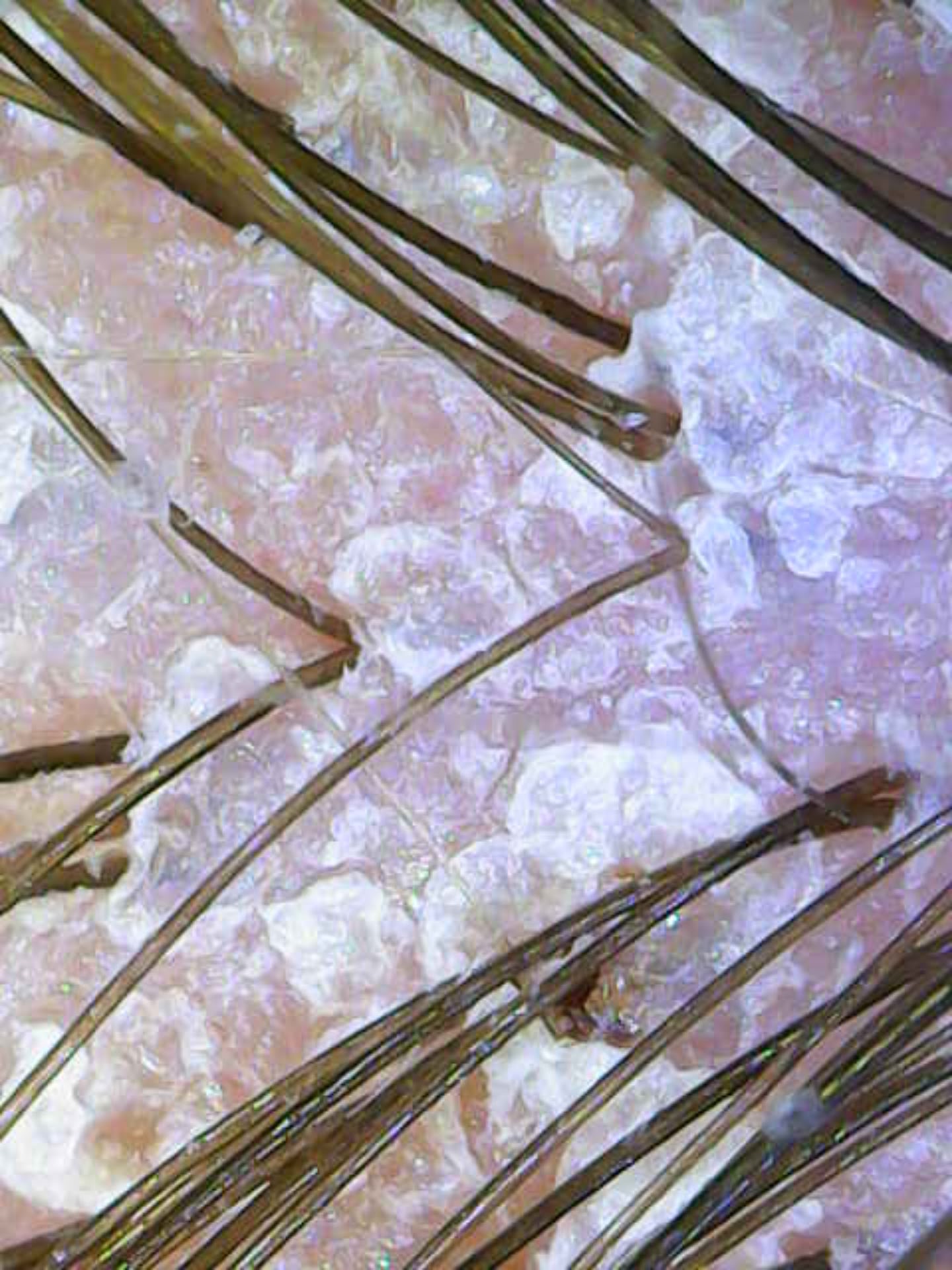 Vorher: Psoriasis (Schuppenflechte)